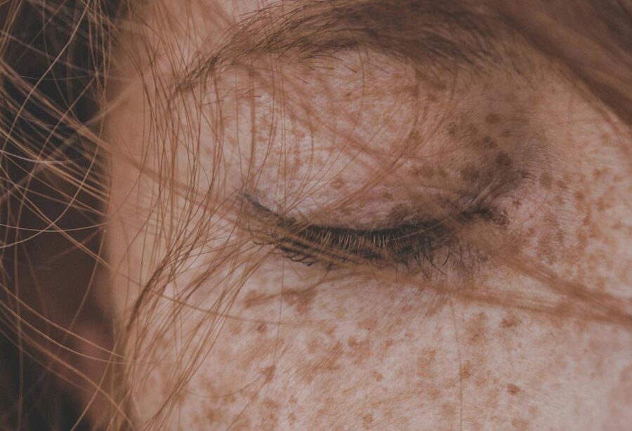 Pigmentflecken im Gesicht - Ursachen und Behandlung