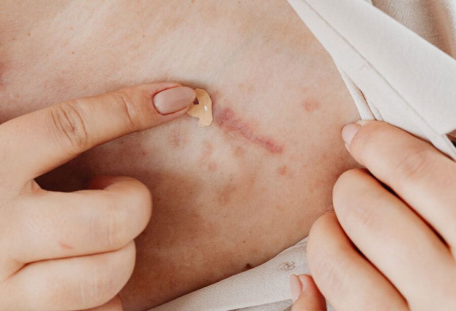 Narbenpflege - Leitfaden für optimale Ergebnisse